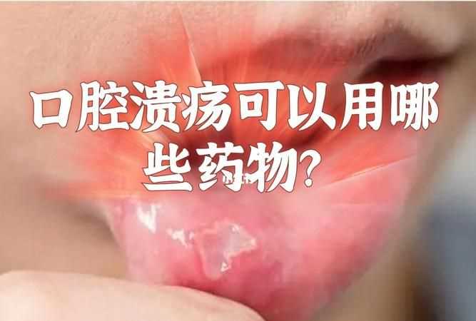 治口腔潰瘍的好方法