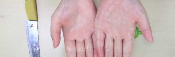 辣椒辣手最快解決辦法多久會好,吃辣椒辣手最快解決辦法圖6