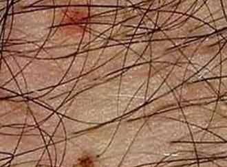 陰虱在床單上能活多久