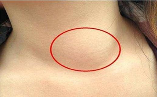 女人艾滋病最明顯特征 女人艾滋病最明顯特征