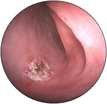 胃息肉的藥物治療方法有哪些