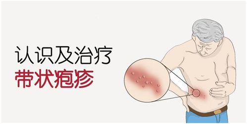 治療皰疹的最好土方法有哪些