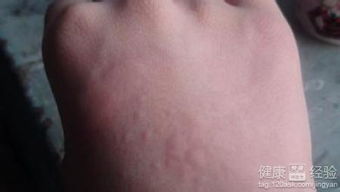 人工性蕁麻疹根治方法有哪些