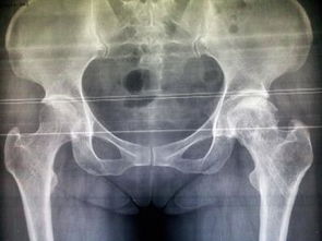 股骨頭壞死的保守治療方法有哪些