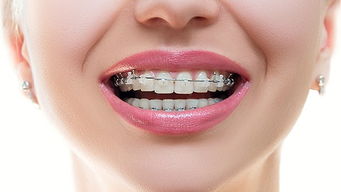 牙齒的矯正方法有哪些