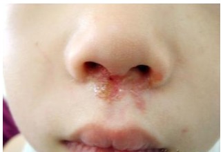 黃水瘡治療方法有哪些