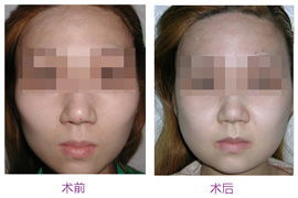 顴骨顴弓降低都有哪些方法