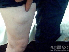 脂肪瘤的中醫(yī)治療方法有哪些