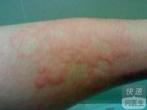 小兒蕁麻疹的護(hù)理方法有哪些