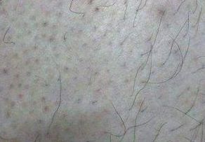 毛囊炎能用哪些方法治療方法