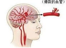 腦出血后遺癥有哪些康復(fù)方法