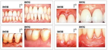 醫(yī)院治療牙周炎一般有哪些方法