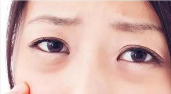 治療眼袋好方法有哪些