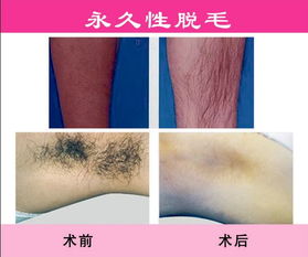 廣東脫毛有哪些方法