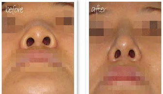 鼻孔縮小可以用什么方法有哪些方法