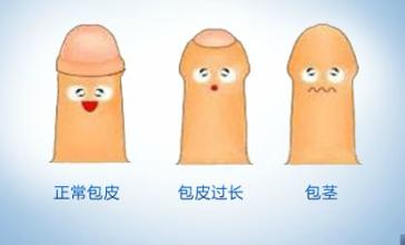 常用包皮過長治療方法有哪些