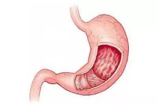 胃炎檢查方法有哪些方面