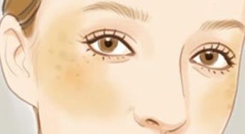 快速黃褐斑的方法有哪些方法