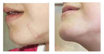 手術(shù)去疤的方法有哪些