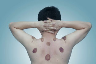 有哪些方法可以袪體內(nèi)濕氣