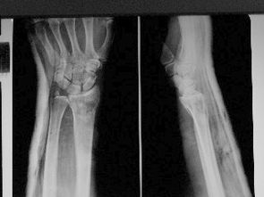 骨折復(fù)位方法有哪些