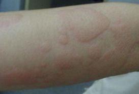 蕁麻疹根治的方法有哪些