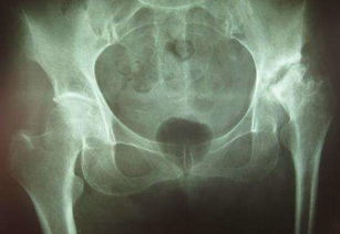 治股骨頭壞死的方法有哪些