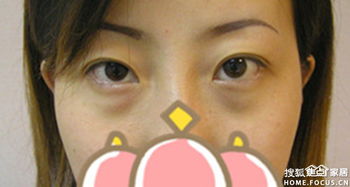 長(zhǎng)沙去眼袋醫(yī)院有哪些方法