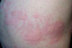 治療蕁麻疹簡單方法有哪些