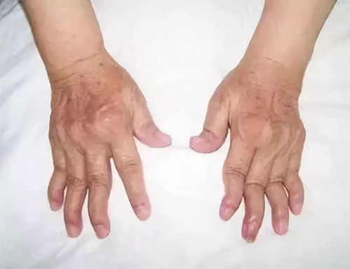 類風(fēng)濕的主要治療方法有哪些