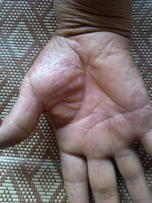 手蘚有哪些癥狀和治療方法