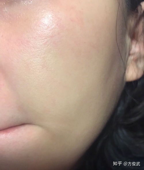 去紅血絲什么好方法有哪些