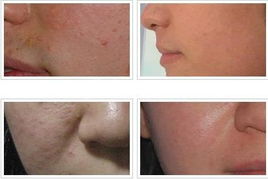 去痘痘去痘印的方法有哪些