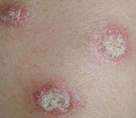 中醫(yī)治療銀屑病的方法有哪些