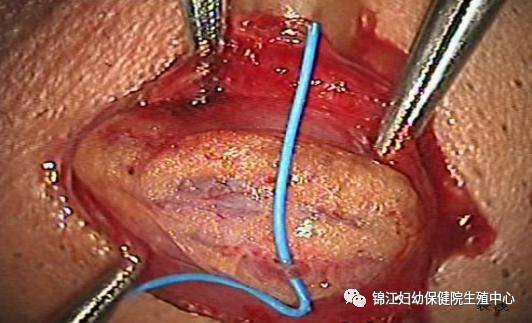 男性手術(shù)都有哪些方法