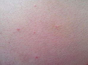 牛皮癬偏方治療方法有哪些