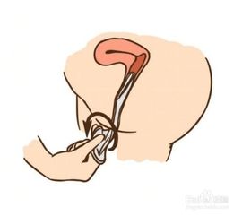 情侶通過哪些方法避孕