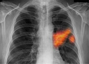 非小細(xì)胞肺癌檢查方法有哪些