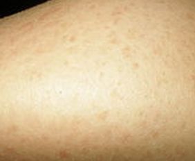 魚鱗病的手護理方法有哪些