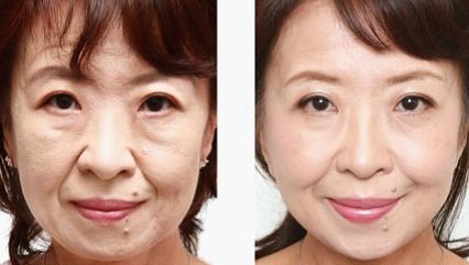 除皺方法主要有哪些如何快速去皺