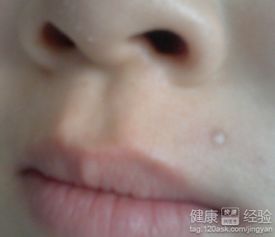 點(diǎn)痣后怎么修復(fù)最好方法有哪些