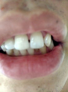 牙齒收縫方法有哪些