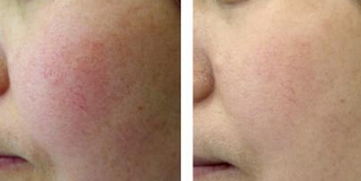 紅血絲修復(fù)有哪些方法