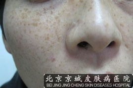 雀斑的最好治療方法有哪些