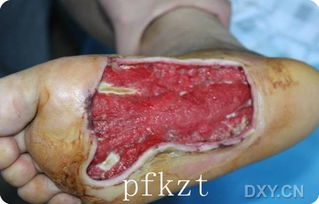 創(chuàng)面修復(fù)的方法主要有哪些