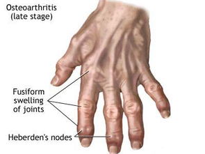 風(fēng)濕病怎么治最佳方法有哪些