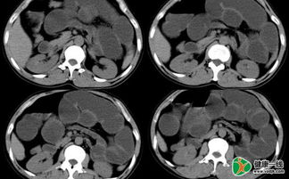 查明腸梗阻的原因有哪些檢查方法