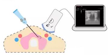 甲狀腺結(jié)節(jié)最佳檢查方法有哪些