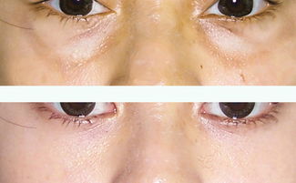 上海哪些醫(yī)院能去眼袋手術(shù)醫(yī)院最好的方法