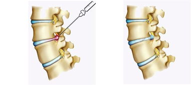 腰腿痛的手術(shù)治療方法有哪些